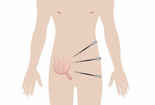 appendix removal scar